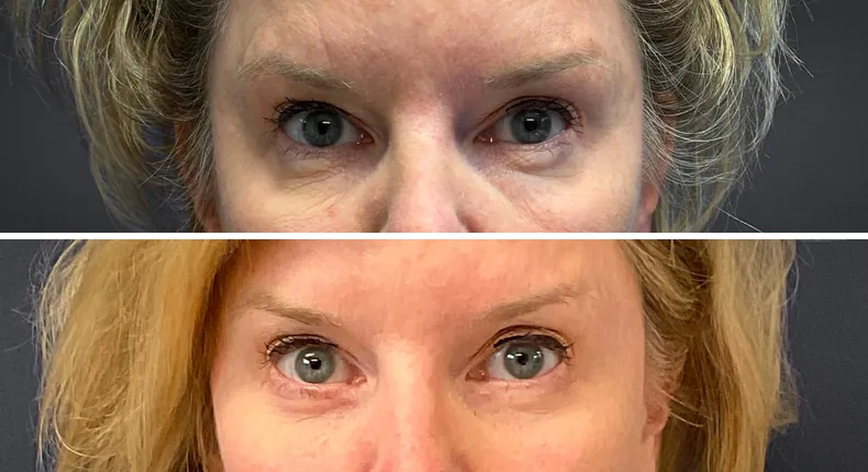 Before and after eyelid surgery: patient's eyes from the front