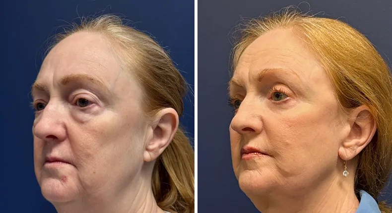 Before and after eyelid surgery: patient's eyes from the left side, with Face360, facelift, facial fat grafting and neck lift