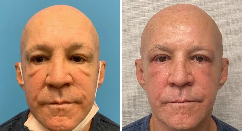 Before and after eyelid surgery: woman's eyes from the front