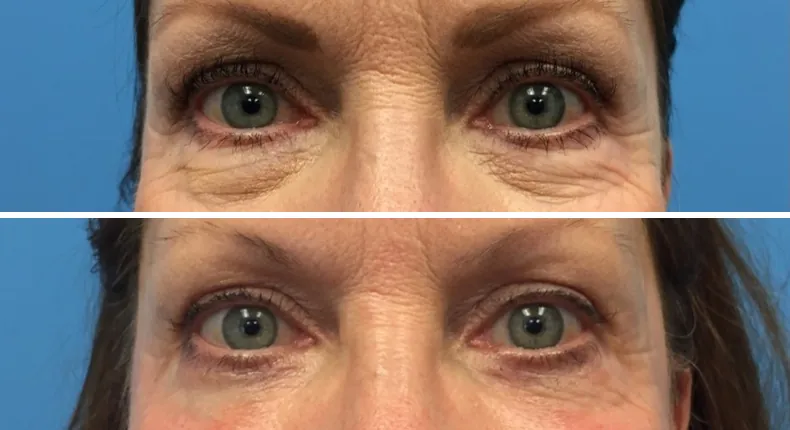 Before and after eyelid surgery: patient's eyes