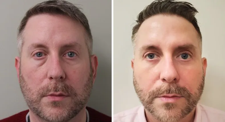 Before and after eyelid surgery: patient's eyes from the front