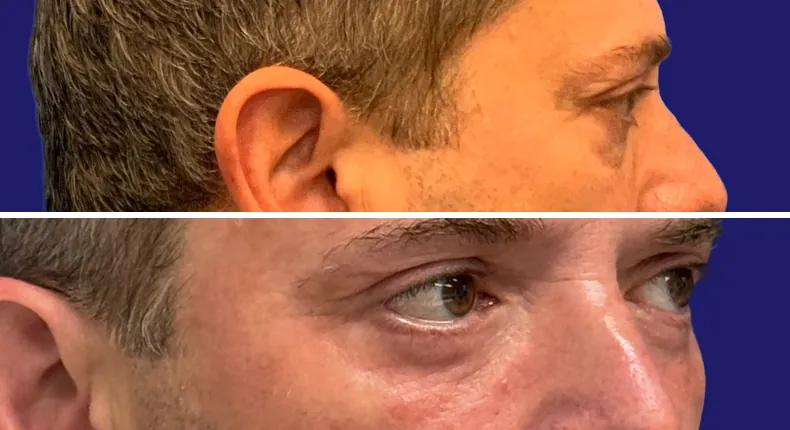 Before and after eyelid surgery: man's eyes, with liposuction