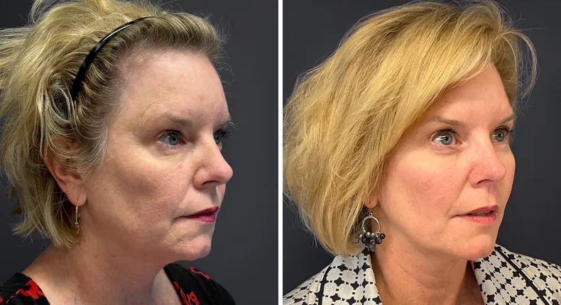 Before and after eyelid surgery: patient's eyes at a right angle
