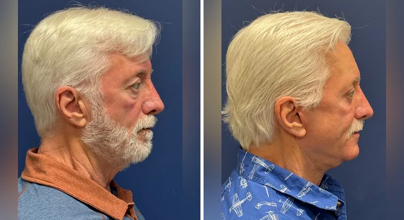 Before and after eyelid surgery: patient's eyes from the right side, with Face360, facelift, facial fat grafting and neck lift