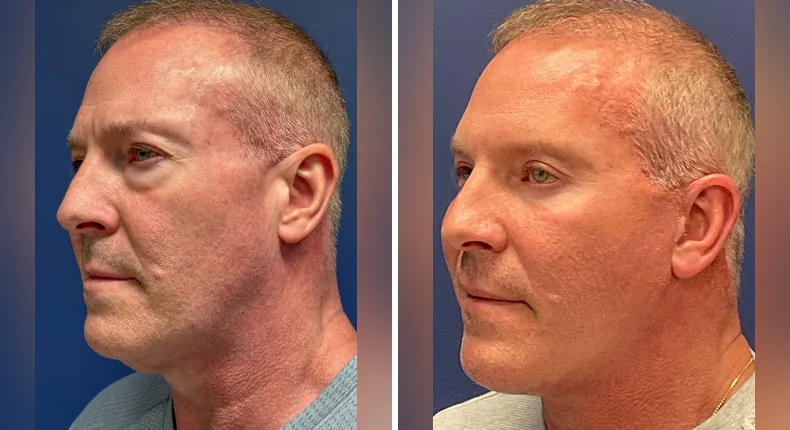 Before and after eyelid surgery: patient's eyes from the left side, with Face360, facelift and neck lift