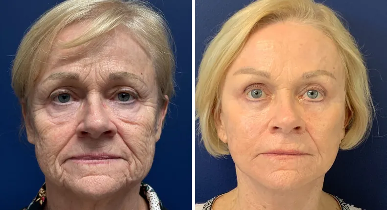 Before and after Face360: patient's face, with facelift, facial fat grafting and neck lift