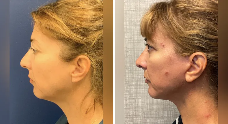 Before and after Face360: woman's face in left profile, with facelift, facial fat grafting, neck lift and eyelid surgery