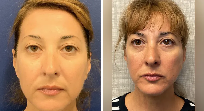 Before and after Face360: woman's face from the front, with facelift, facial fat grafting, neck lift and eyelid surgery