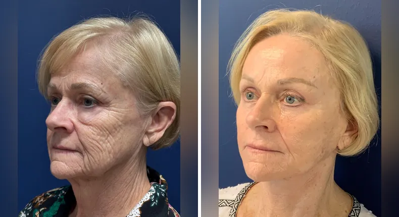 Before and after Face360: patient's face from the left side, with facelift, facial fat grafting and neck lift