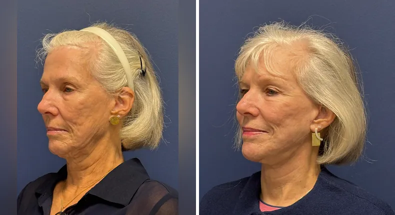 Before and after Face360: patient's face from the left side, with facelift, facial fat grafting and neck lift