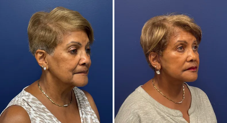 Before and after Face360: patient's face from the right side, with facelift, facial fat grafting and neck lift