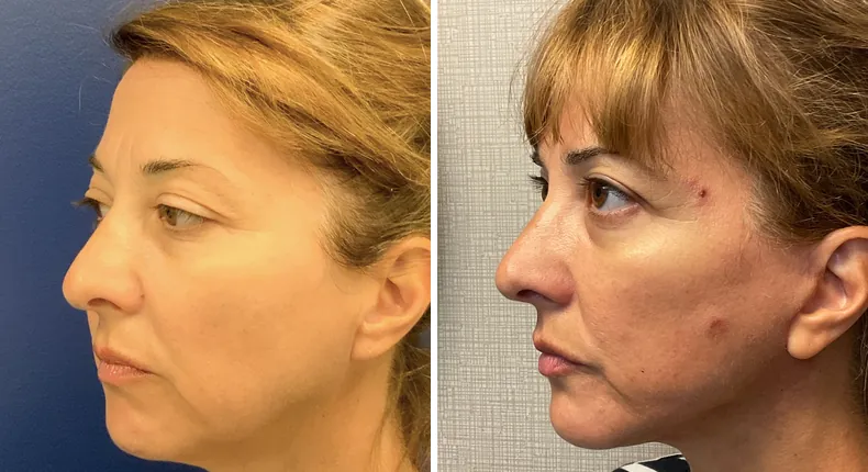 Before and after Face360: woman's face at a left angle, with facelift, facial fat grafting, neck lift and eyelid surgery