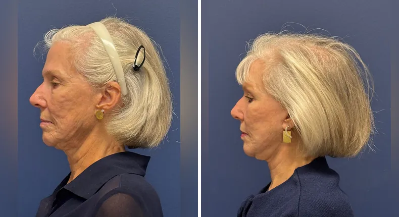 Before and after Face360: patient's face from the left side, with facelift, facial fat grafting and neck lift