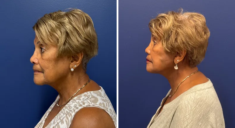 Before and after Face360: patient's face from the left side, with facelift, facial fat grafting and neck lift