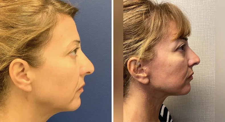 Before and after Face360: woman's face in right profile, with facelift, facial fat grafting, neck lift and eyelid surgery