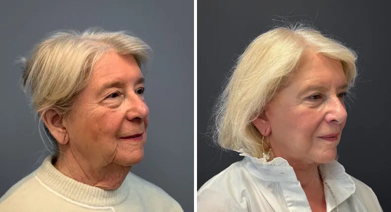 Before and after Face360: patient's face at a right angle, with facelift, facial fat grafting and neck lift