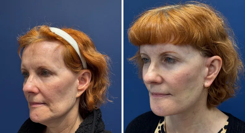 Before and after Face360: patient's face from the left side, with facelift, facial fat grafting and neck lift