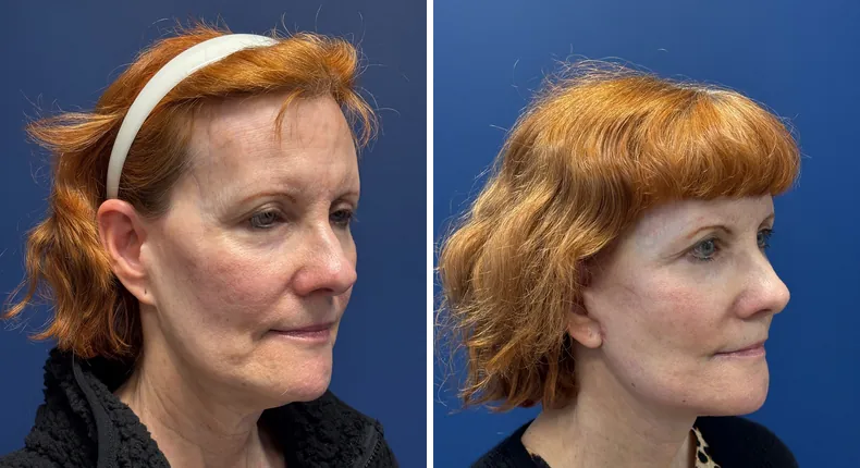 Before and after Face360: patient's face from the right side, with facelift, facial fat grafting and neck lift