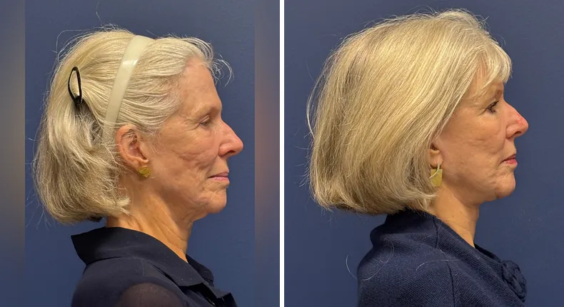 Before and after Face360: patient's face from the right side, with facelift, facial fat grafting and neck lift