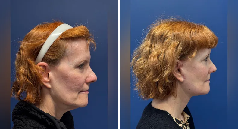 Before and after Face360: patient's face from the right side, with facelift, facial fat grafting and neck lift