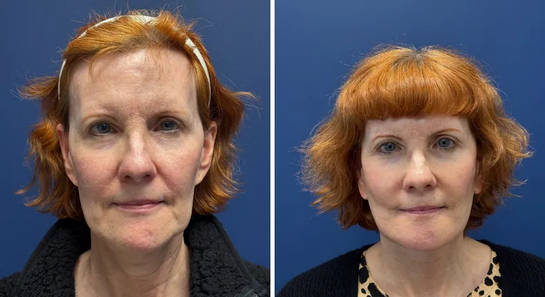 Before and after Face360: patient's face, with facelift, facial fat grafting and neck lift