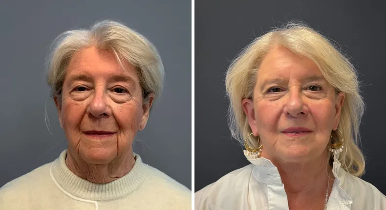 Before and after Face360: patient's face from the front, with facelift, facial fat grafting and neck lift
