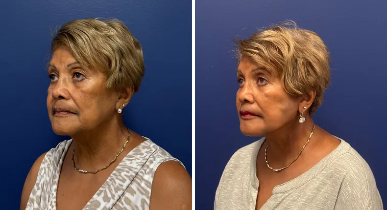 Before and after Face360: patient's face from the left side, with facelift, facial fat grafting and neck lift