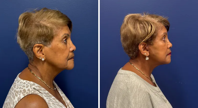 Before and after Face360: patient's face from the right side, with facelift, facial fat grafting and neck lift