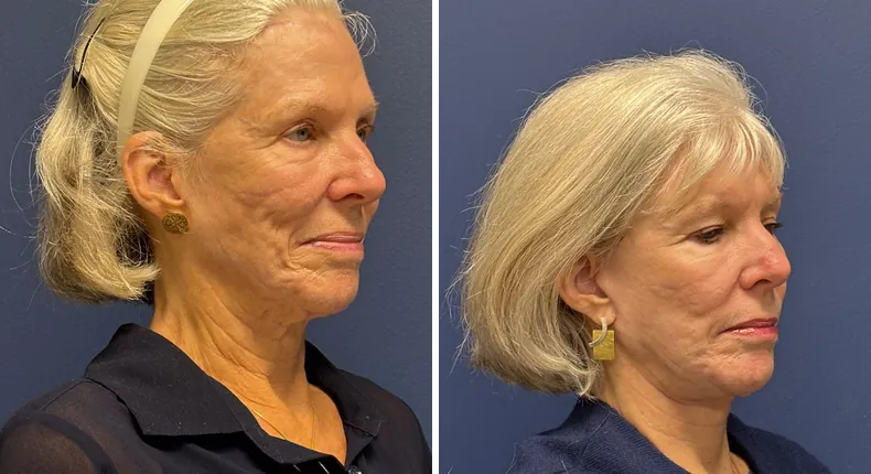 Before and after Face360: patient's face from the right side, with facelift, facial fat grafting and neck lift