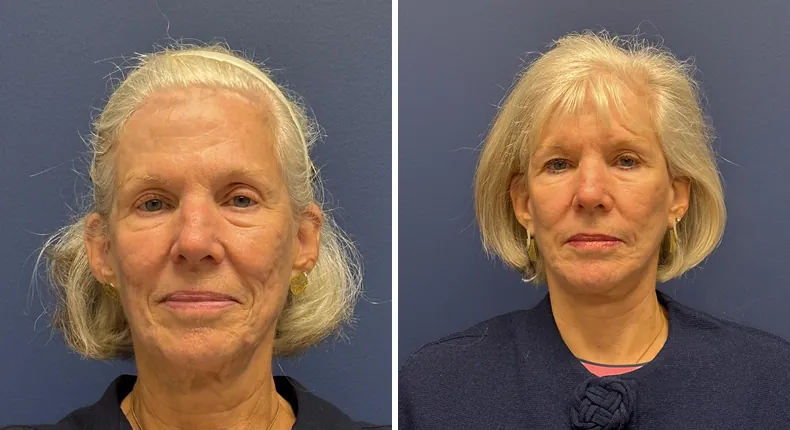 Before and after Face360: patient's face, with facelift, facial fat grafting and neck lift