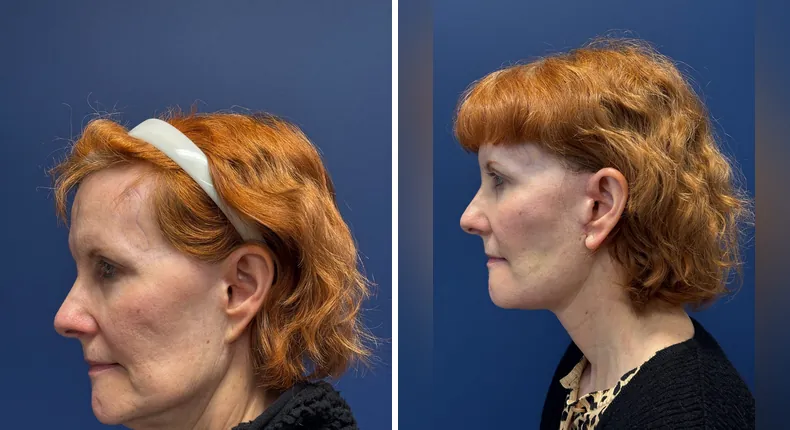 Before and after Face360: patient's face from the left side, with facelift, facial fat grafting and neck lift