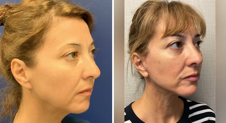 Before and after Face360: woman's face at a right angle, with facelift, facial fat grafting, neck lift and eyelid surgery
