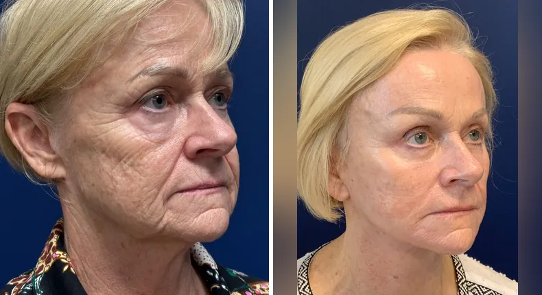 Before and after Face360: patient's face from the right side, with facelift, facial fat grafting and neck lift