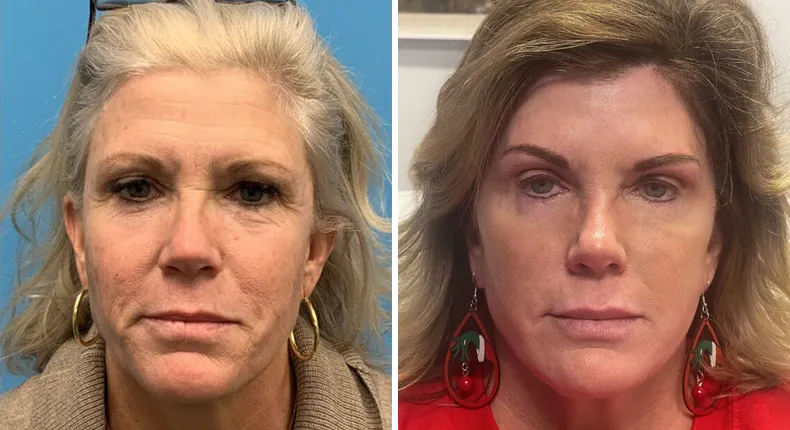 Before and after Face360: woman's face from the front
