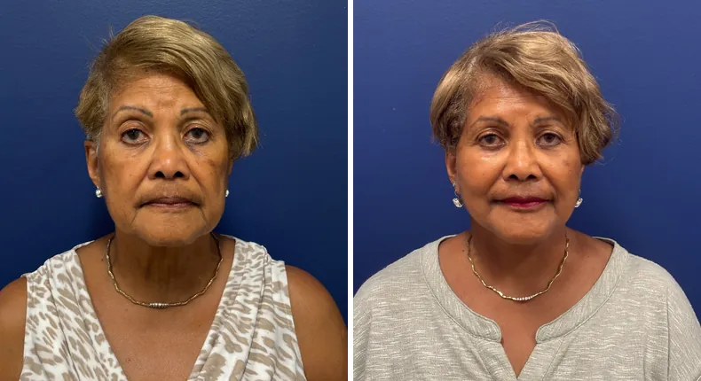 Before and after Face360: patient's face, with facelift, facial fat grafting and neck lift