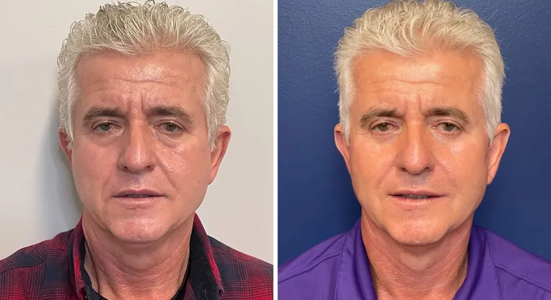 Before and after male facelift: patient's face from the front