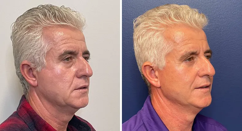 Before and after male facelift: patient's face at a right angle