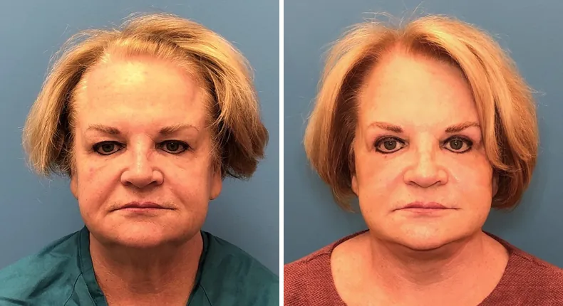 Before and after facelift: patient's face from the front
