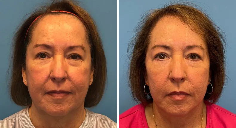 Before and after facelift: woman's face from the front