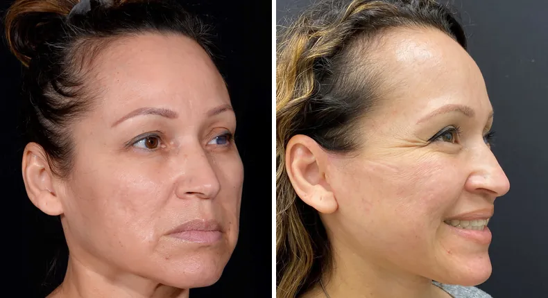 Before and after facelift: patient's face at a right angle