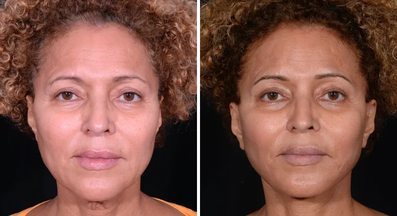 Before and after facelift: patient's face from the front, with neck lift