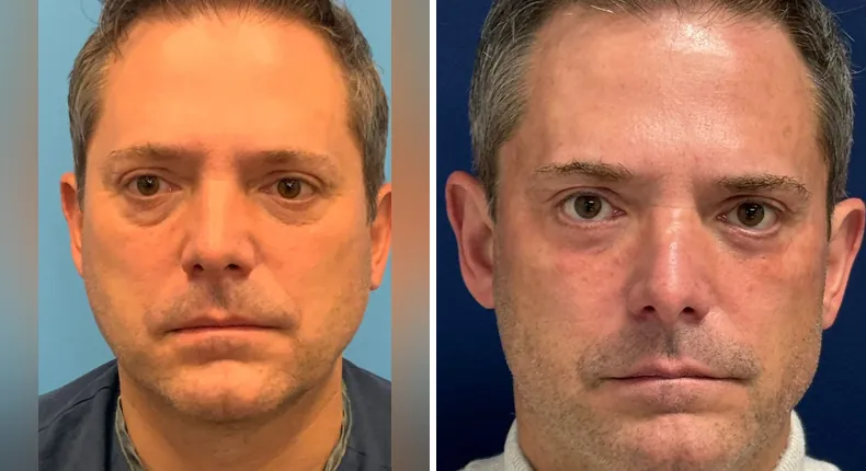 Before and after facelift: man's face