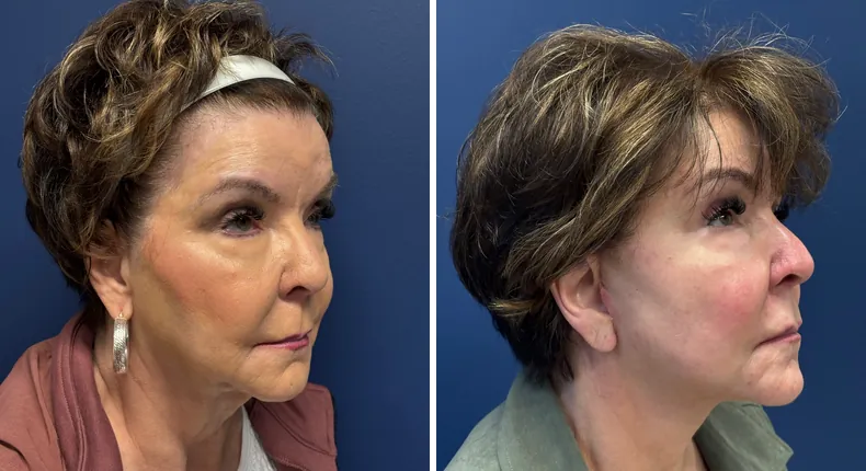 Before and after facelift: patient's face from the right side