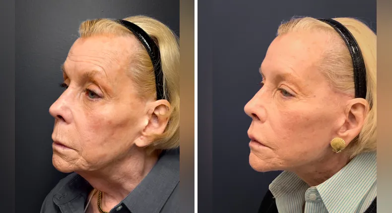 Before and after facelift: patient's face at a left angle