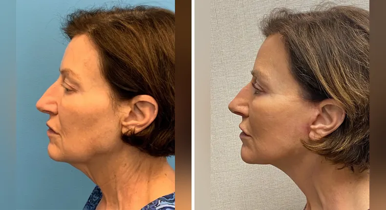 Before and after facelift: woman's face in left profile
