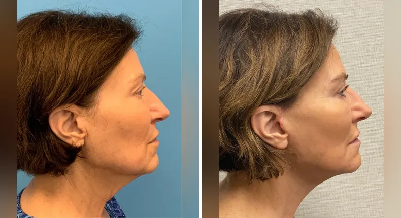 Before and after facelift: woman's face in right profile