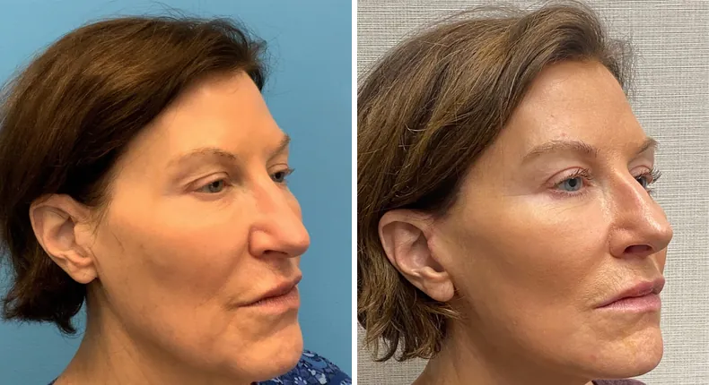 Before and after facelift: woman's face at a right angle