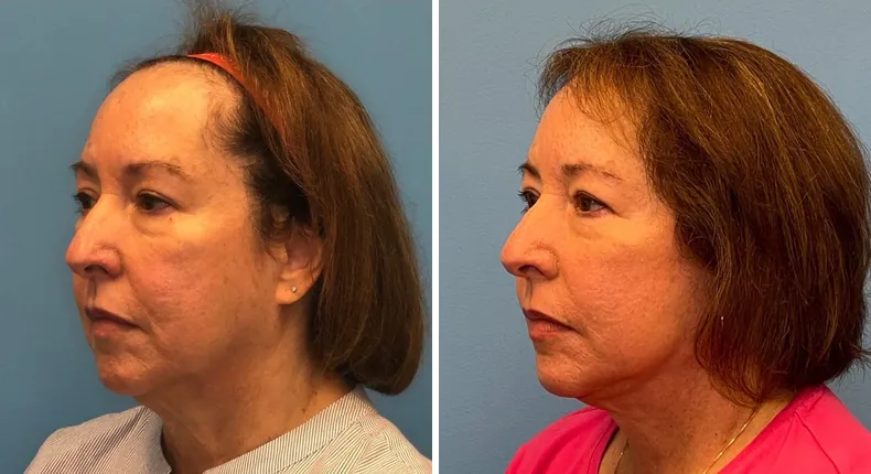 Before and after facelift: woman's face at a left angle