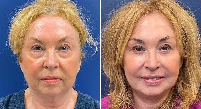 Before and after facelift: woman's face from the front
