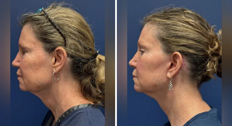 Before and after facelift: patient's face from the left side